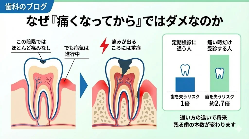 むし歯が進行してから痛みが出る仕組みと、定期検診に通う人と痛い時だけ受診する人では歯を失うリスクが約2.7倍違うことをイラストで解説した図