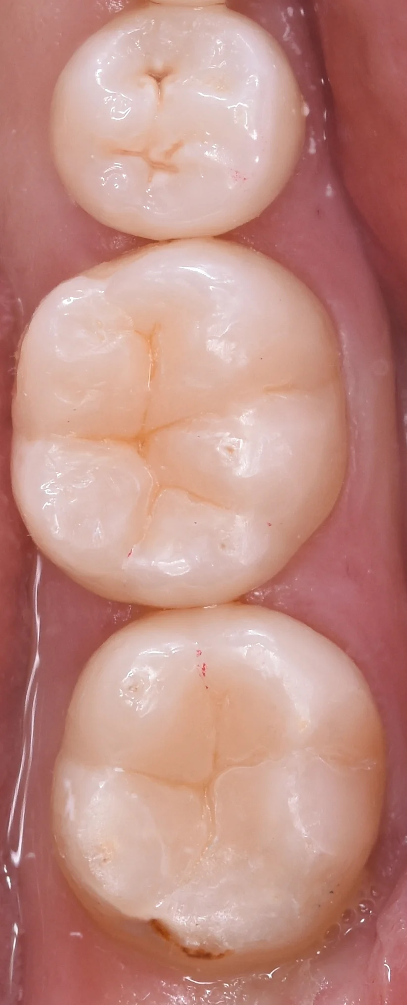 他県にて勤務中の歯科衛生士の方の治療。|坂寄歯科医院(取手市藤代) - 画像4