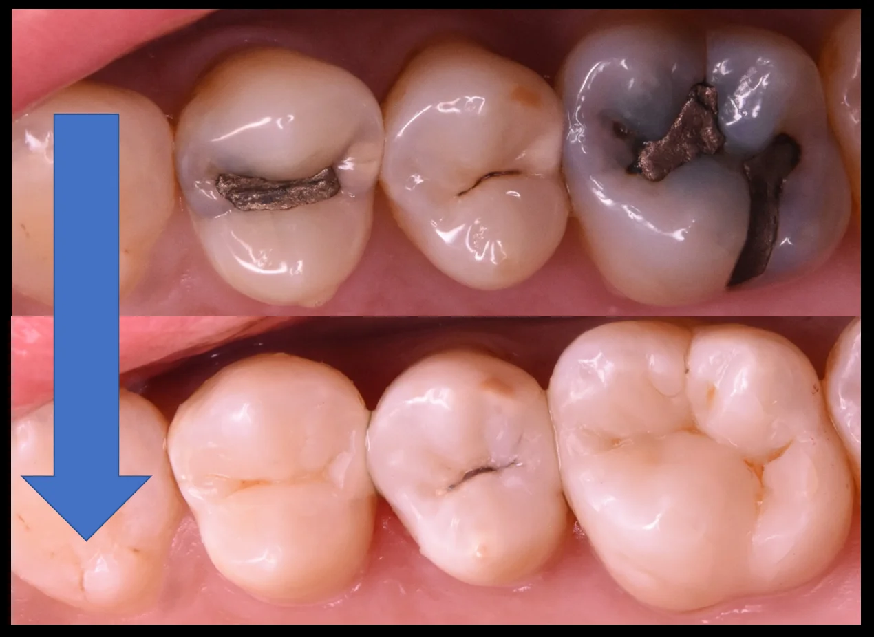 奥歯3本を纏めて一気に治療。｜坂寄歯科医院（取手市藤代） - 画像5