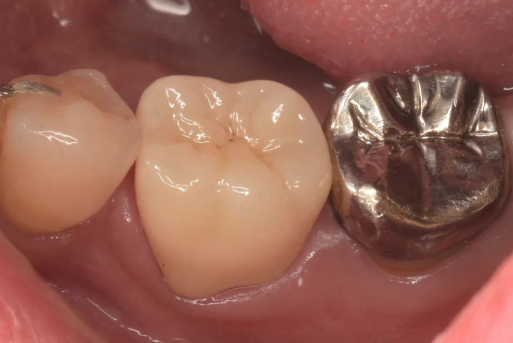 神経の治療後をセラミックで。|坂寄歯科医院(取手市藤代) - 画像3