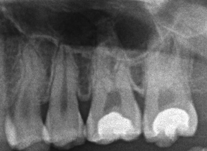 ダイレクトボンディング(処置後3年経過)｜坂寄歯科医院（取手市藤代） - 画像3