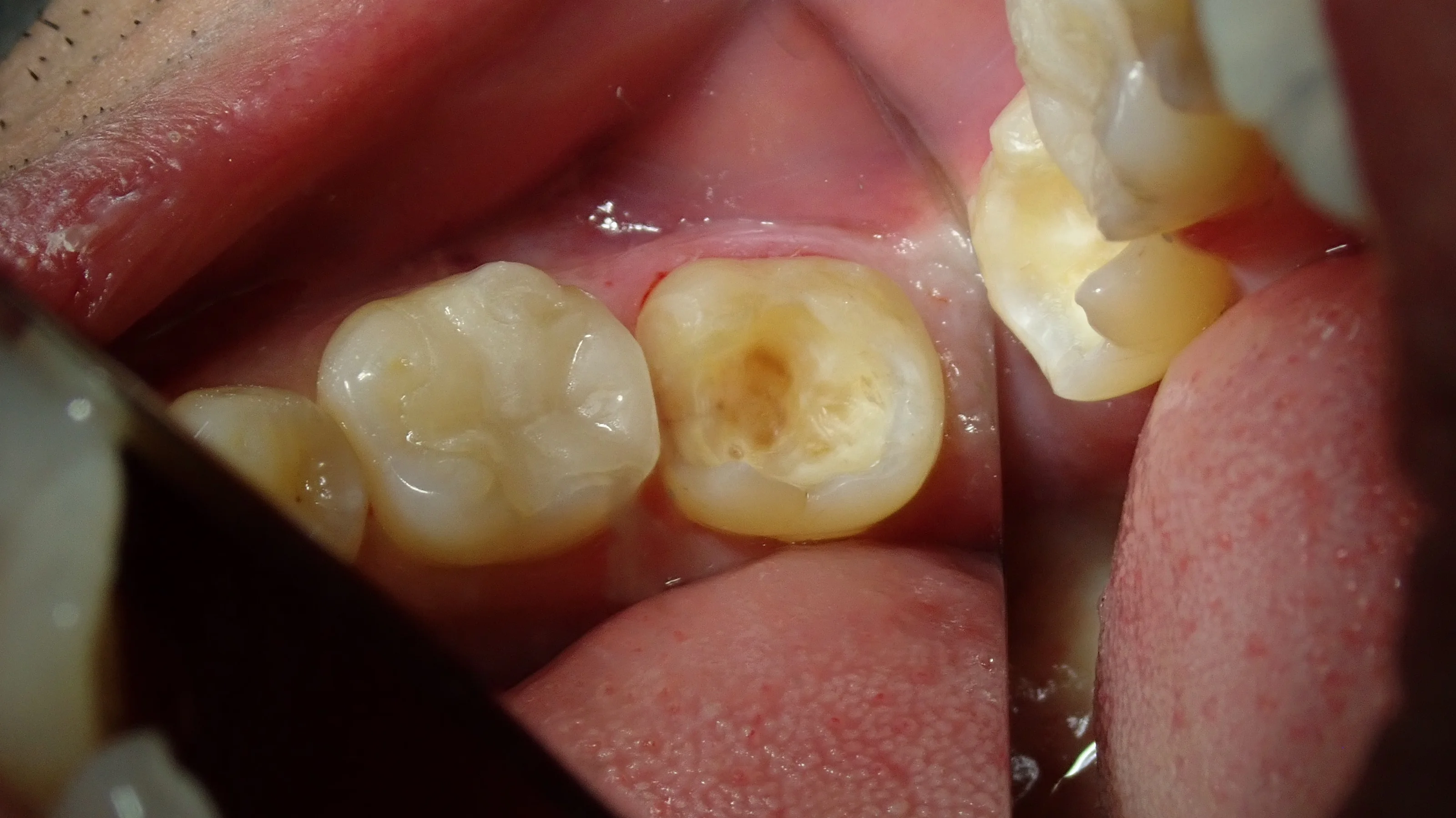 左下奥の白い詰め物|坂寄歯科医院(取手市藤代) - 画像2