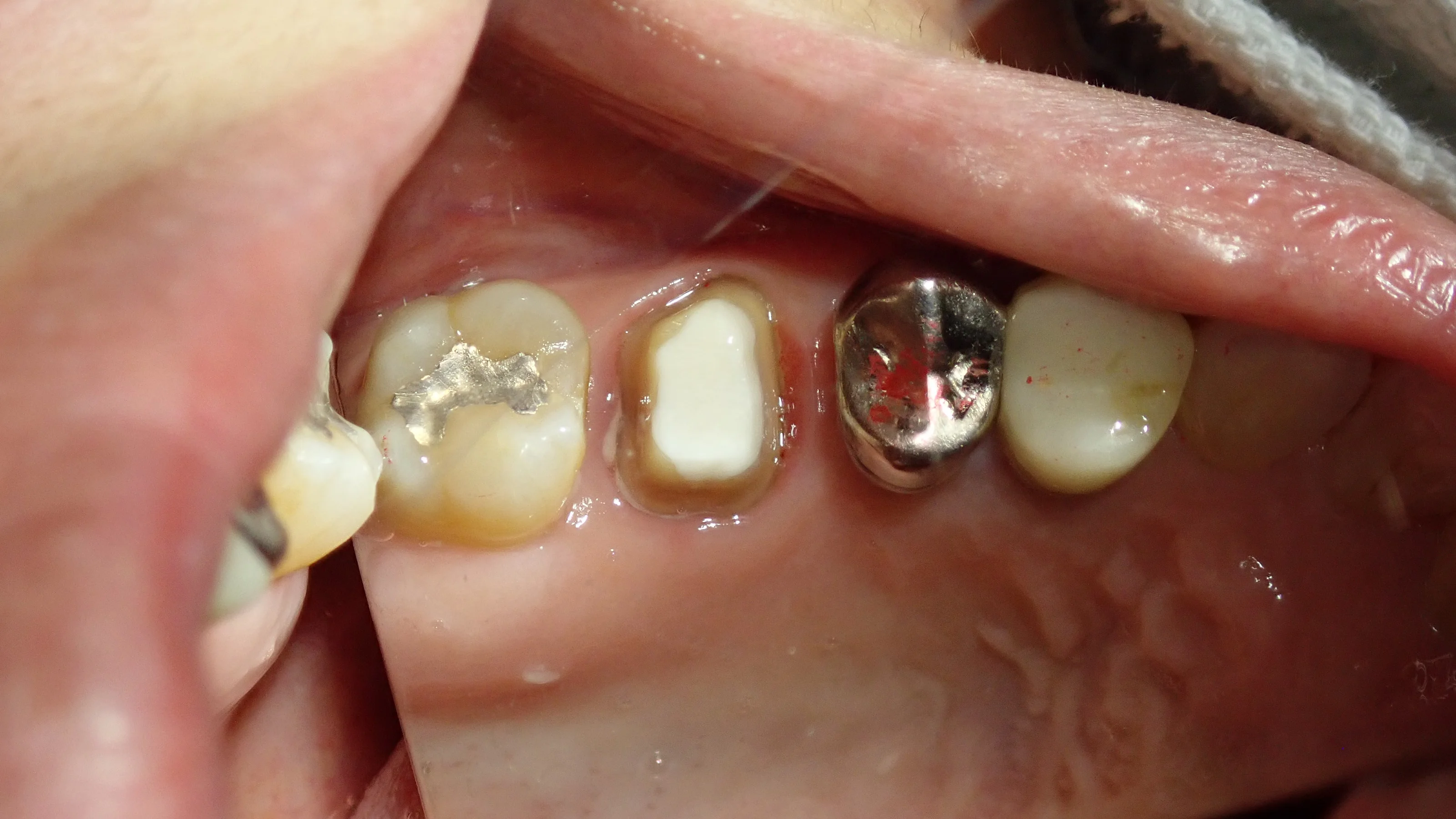 被せ物が無調整で入るとすっごく気持ちいい。｜坂寄歯科医院（取手市藤代） - 画像3
