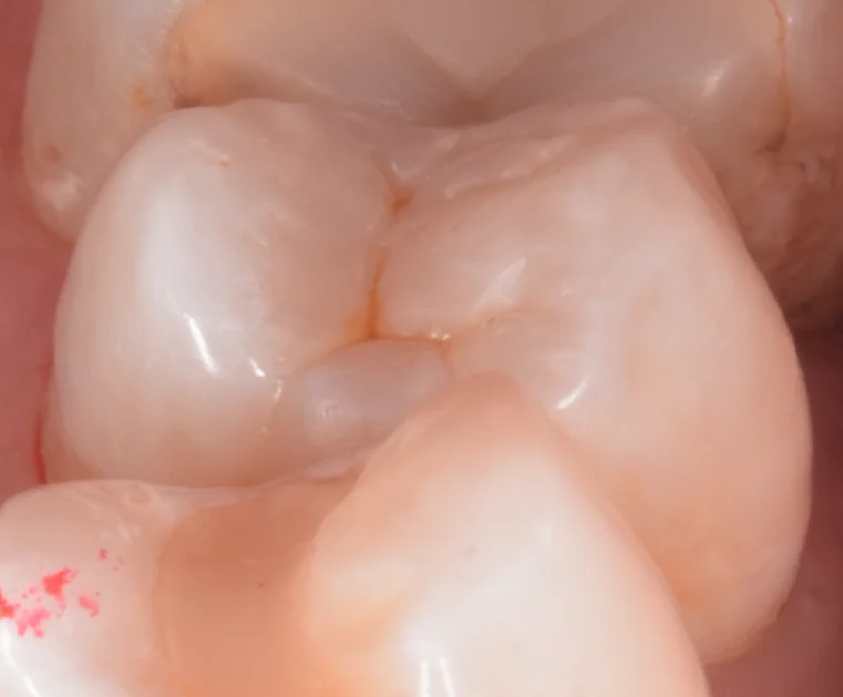 開業歯科医師の方を治療。|坂寄歯科医院(取手市藤代) - 画像5