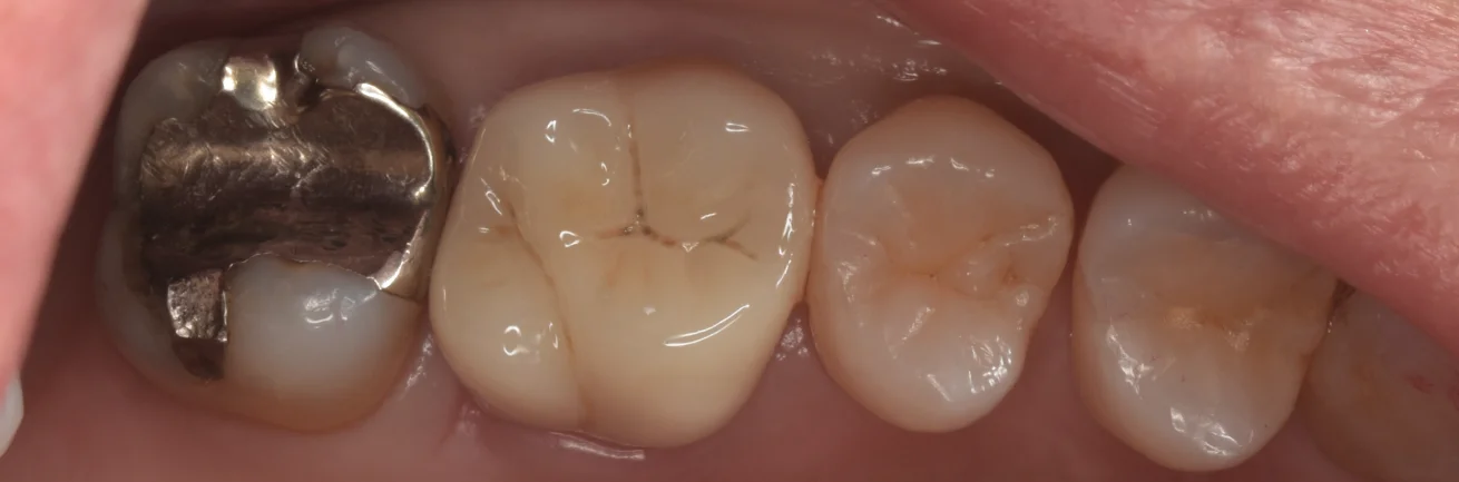虫歯の治療後セラミックの被せ物に。｜坂寄歯科医院（取手市藤代） - 画像2