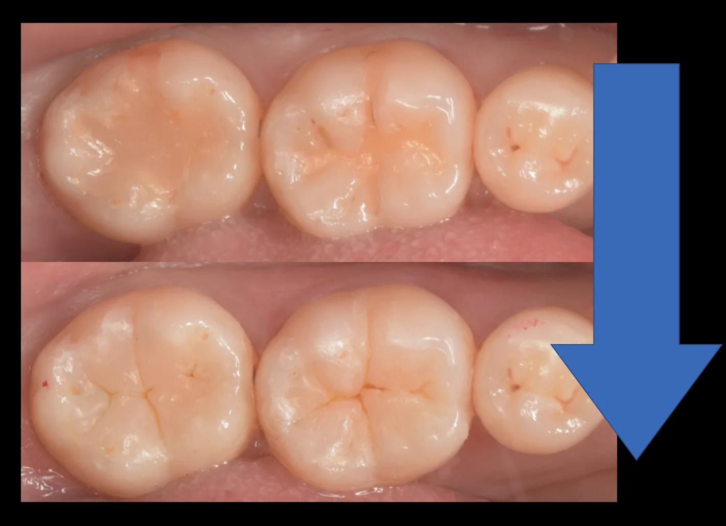 見た目が気になるレジンを天然の歯の様に。｜坂寄歯科医院（取手市藤代） - 画像4