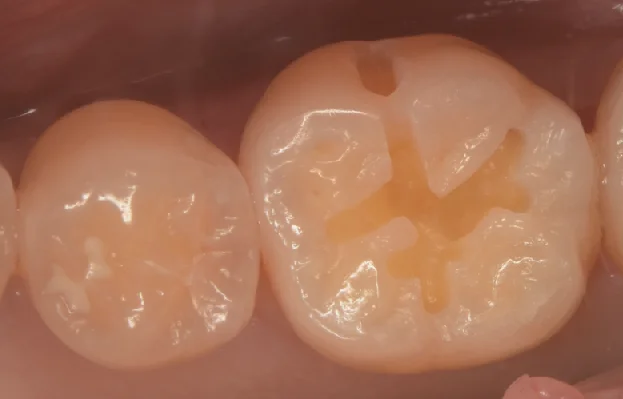 様子を見ていた所が進んだため治療介入。|坂寄歯科医院(取手市藤代) - 画像3