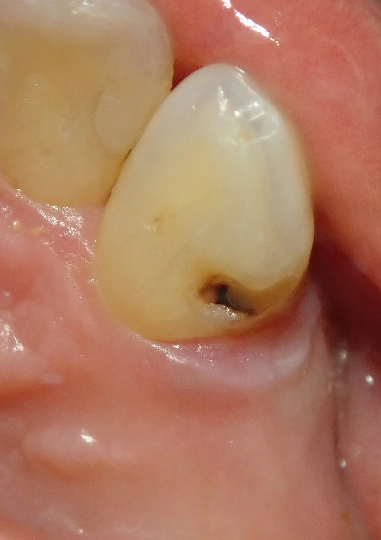 右上犬歯の白い詰め物|坂寄歯科医院(取手市藤代) - 画像2