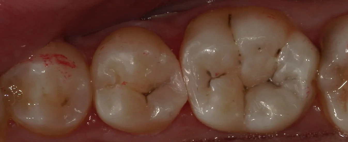 歯科医師の方をダイレクトボンディングにて治療。｜坂寄歯科医院（取手市藤代） - 画像4