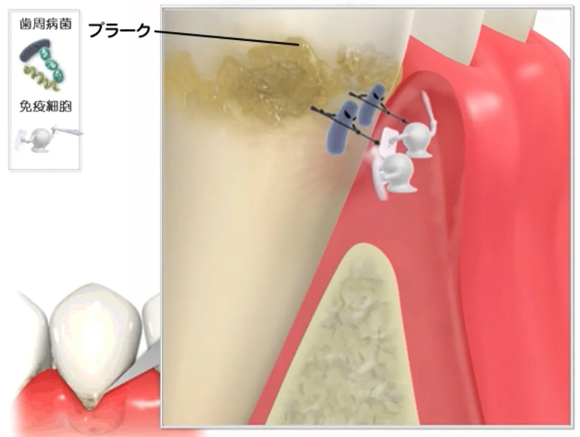 Q&A～歯周病ってなに？①～｜坂寄歯科医院（取手市藤代） - 画像3