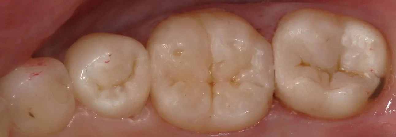 １回で纏めて一気に白い歯へ。｜坂寄歯科医院（取手市藤代） - 画像4