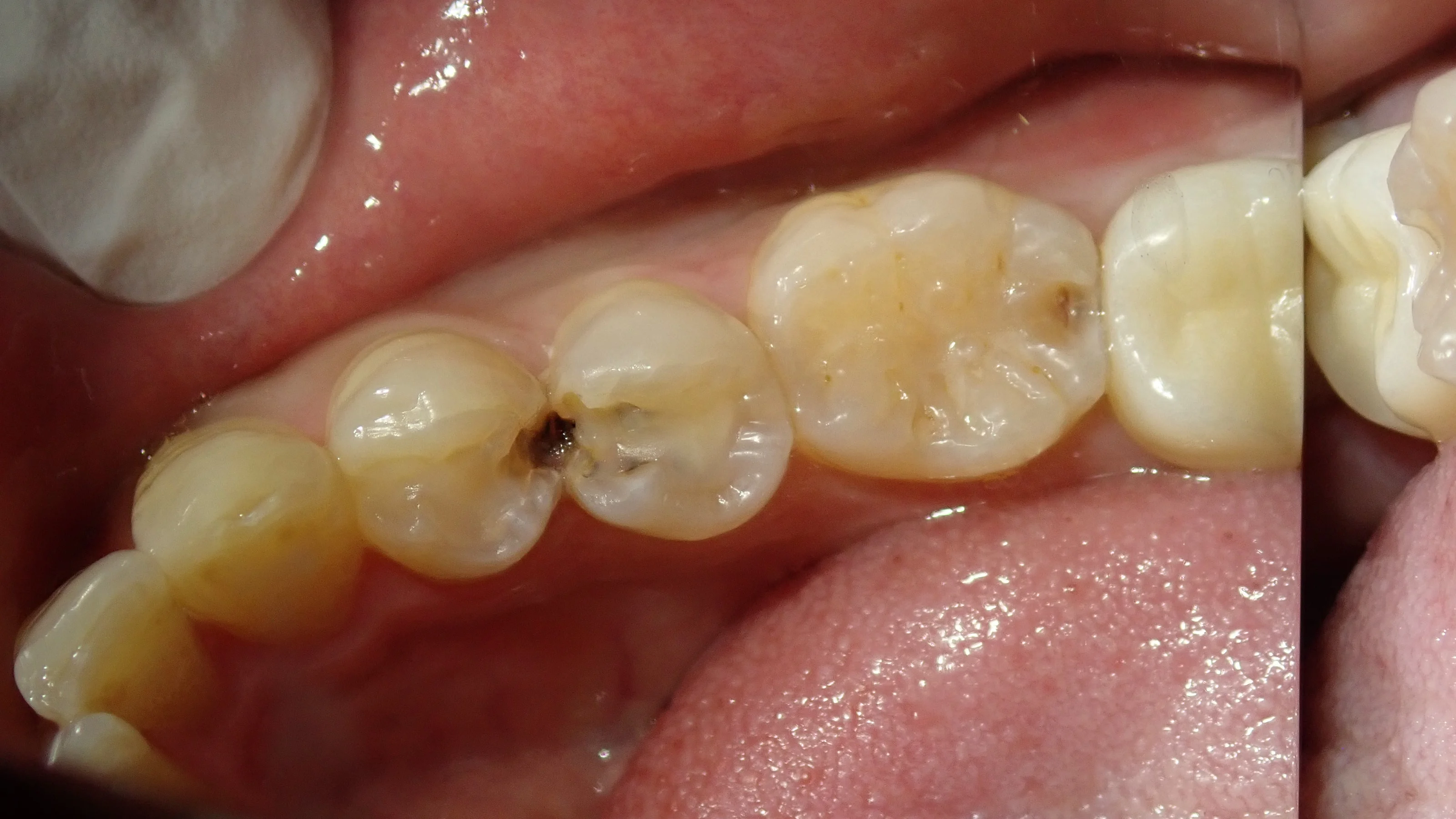 保険の白い詰め物(一気に3本)|坂寄歯科医院(取手市藤代) - 画像2