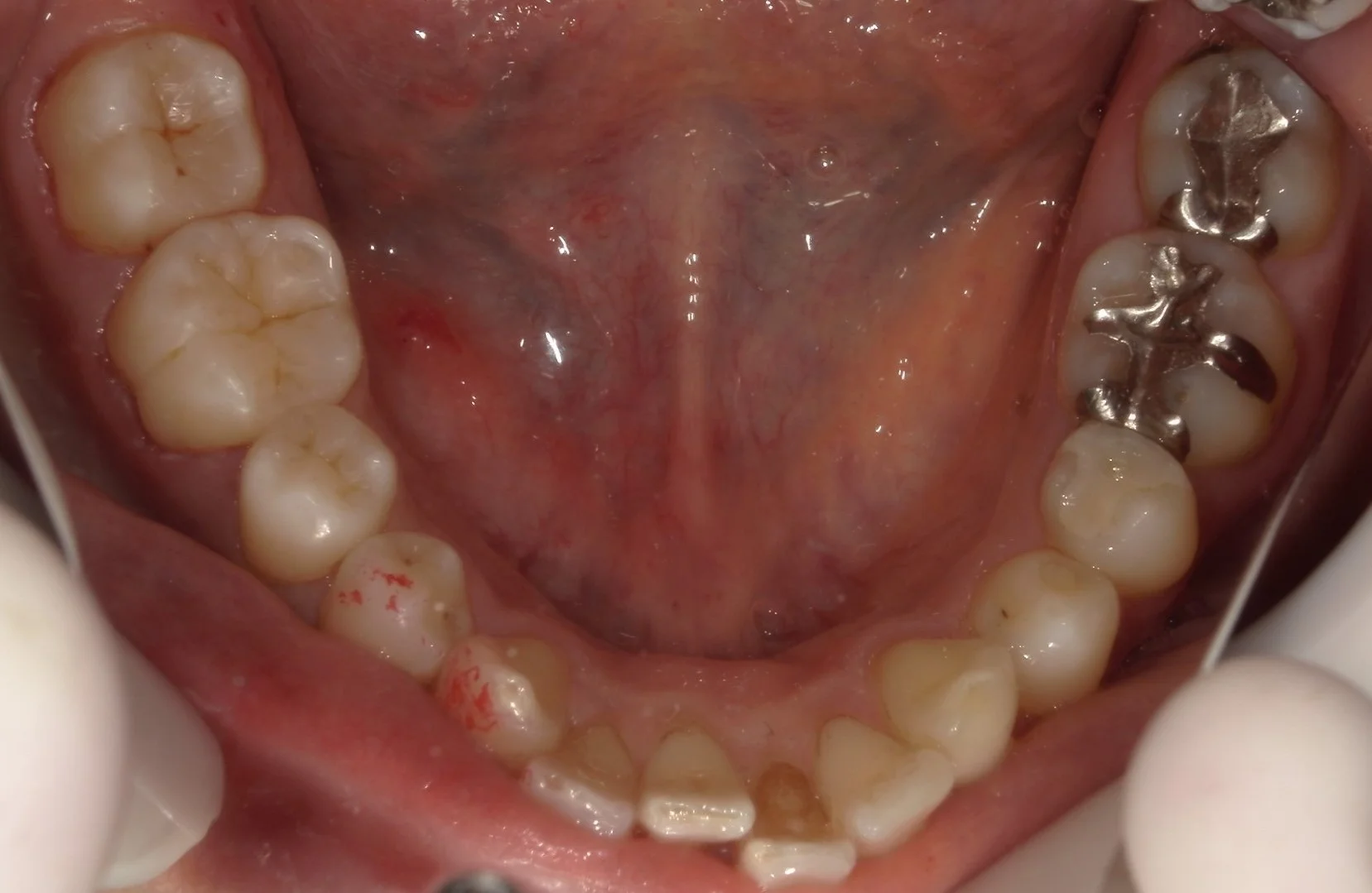 遠方から纏めて治療を希望の方。｜坂寄歯科医院（取手市藤代） - 画像7