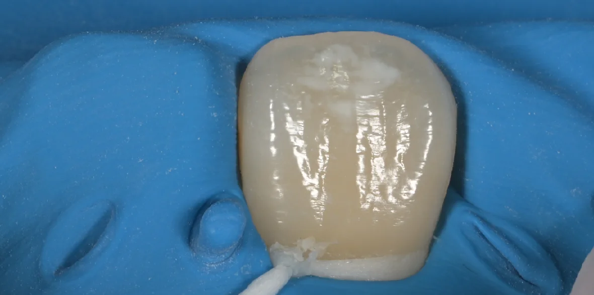 ICON治療にてホワイトスポットを改善。｜坂寄歯科医院（取手市藤代） - 画像3