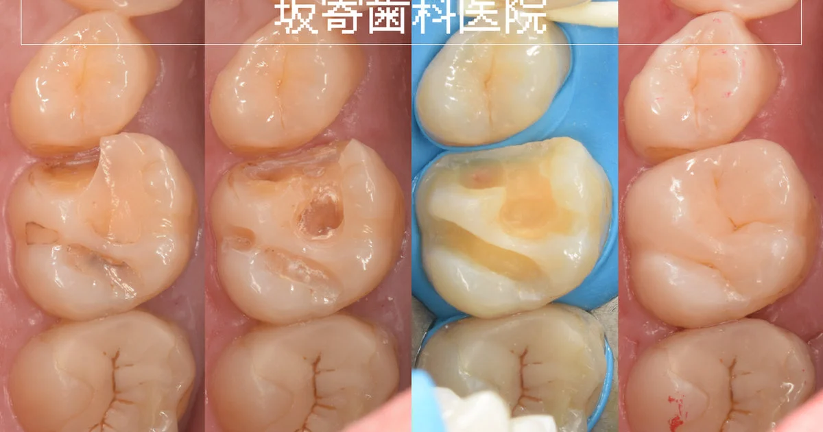 ブログ・お役立ち情報｜坂寄歯科医院（取手市藤代）