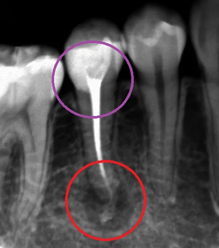 神経の治療③|坂寄歯科医院(取手市藤代) - 画像2