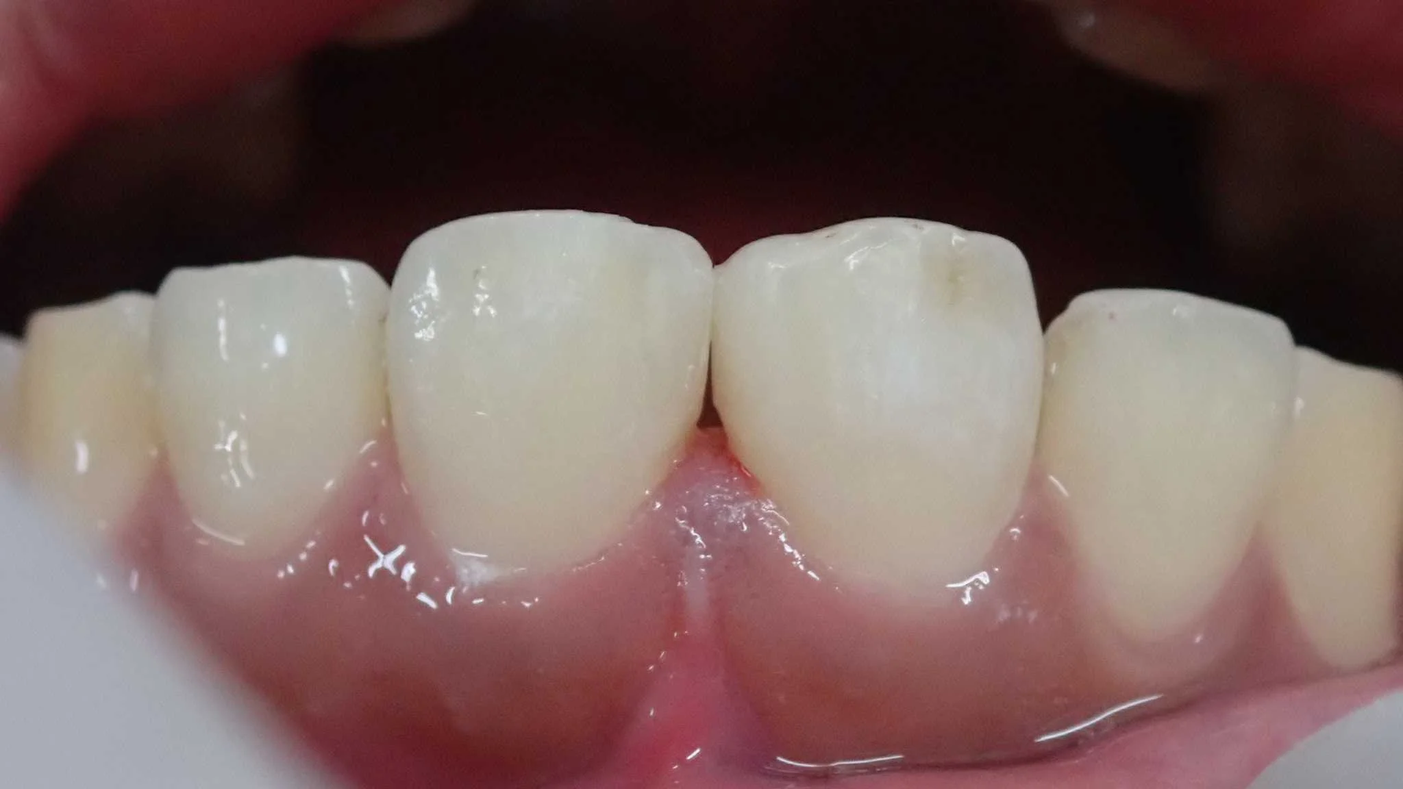 正中離開(すきっ歯)の治療|坂寄歯科医院(取手市藤代) - 画像3