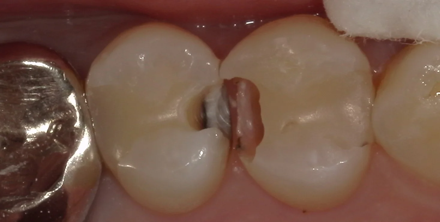 保険内の白い詰め物(コンポジットレジン修復)|坂寄歯科医院(取手市藤代) - 画像2