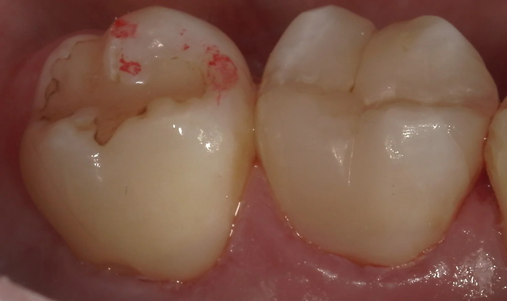 歯の側面も同時に治療したケース。|坂寄歯科医院(取手市藤代) - 画像6