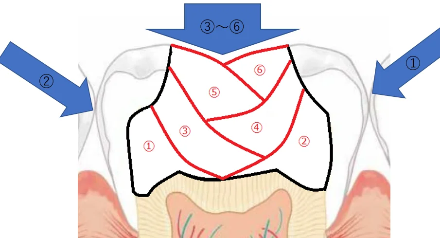 【歯科医師向け】重合収縮のコントロールについて【1級窩洞編】｜坂寄歯科医院（取手市藤代） - 画像5
