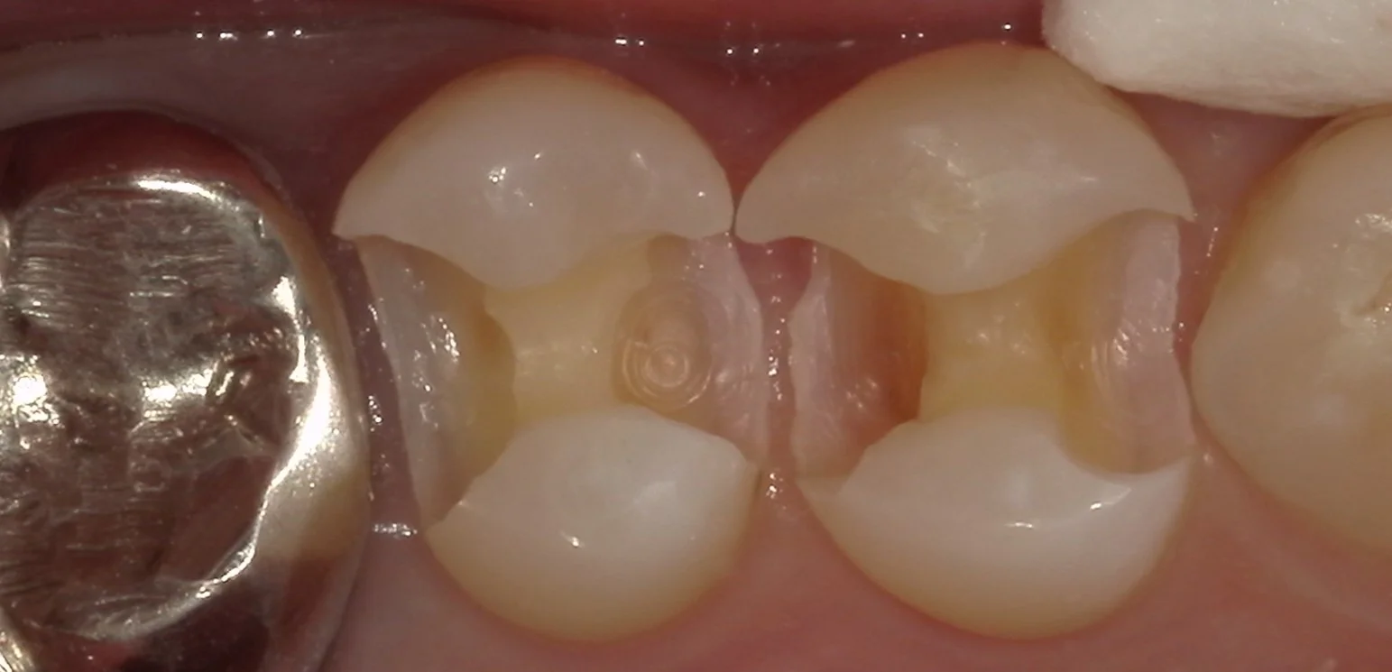 保険内の白い詰め物(コンポジットレジン修復)|坂寄歯科医院(取手市藤代) - 画像3
