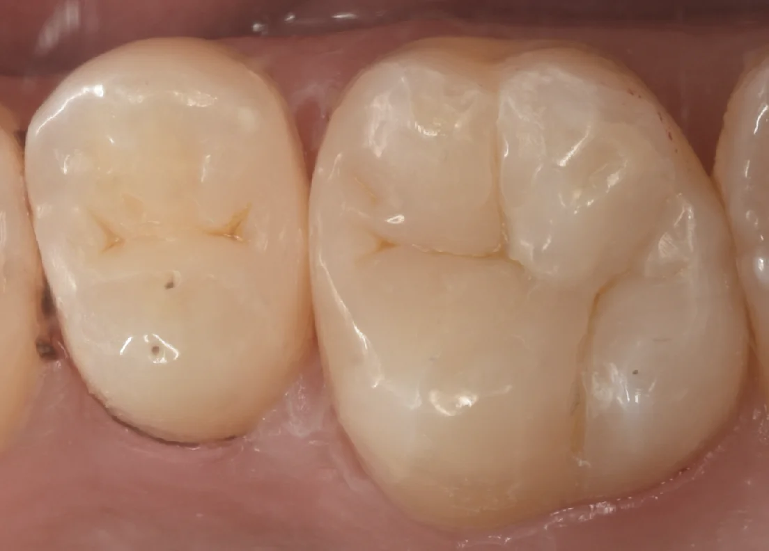 金属の詰め物を白い詰め物に。|坂寄歯科医院(取手市藤代) - 画像3