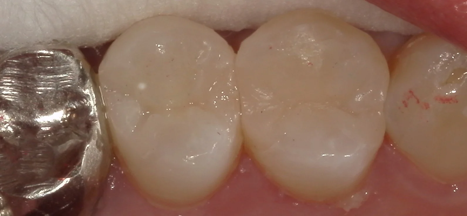 保険内の白い詰め物(コンポジットレジン修復)|坂寄歯科医院(取手市藤代) - 画像4