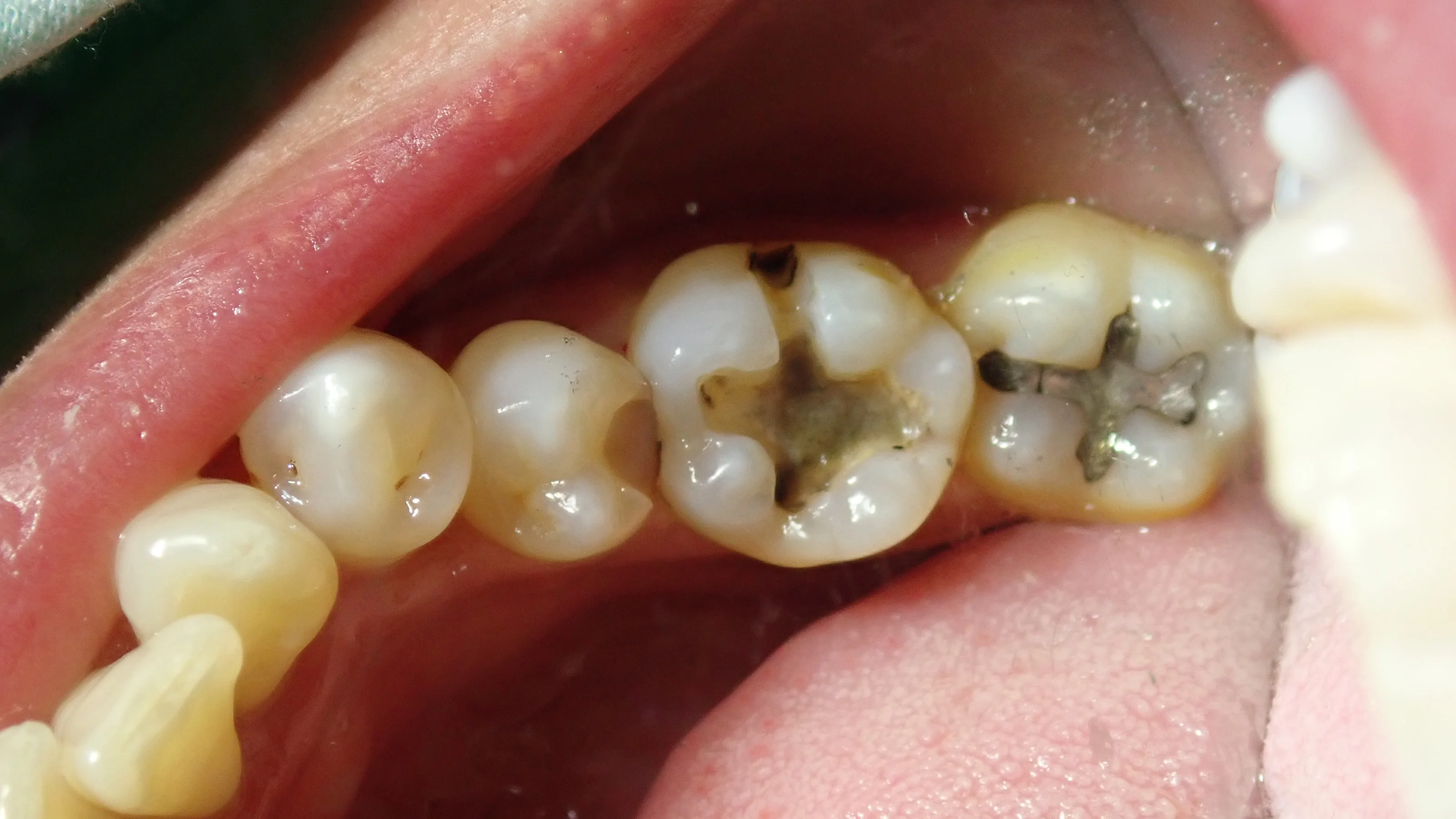 下の奥歯2本の詰め物｜坂寄歯科医院（取手市藤代） - 画像2