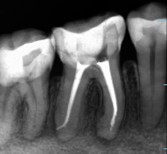 神経の治療②｜坂寄歯科医院（取手市藤代） - 画像3