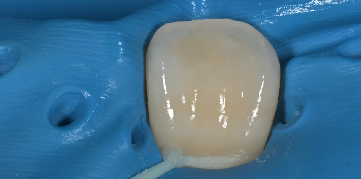 ICON治療にてホワイトスポットを改善。｜坂寄歯科医院（取手市藤代） - 画像4