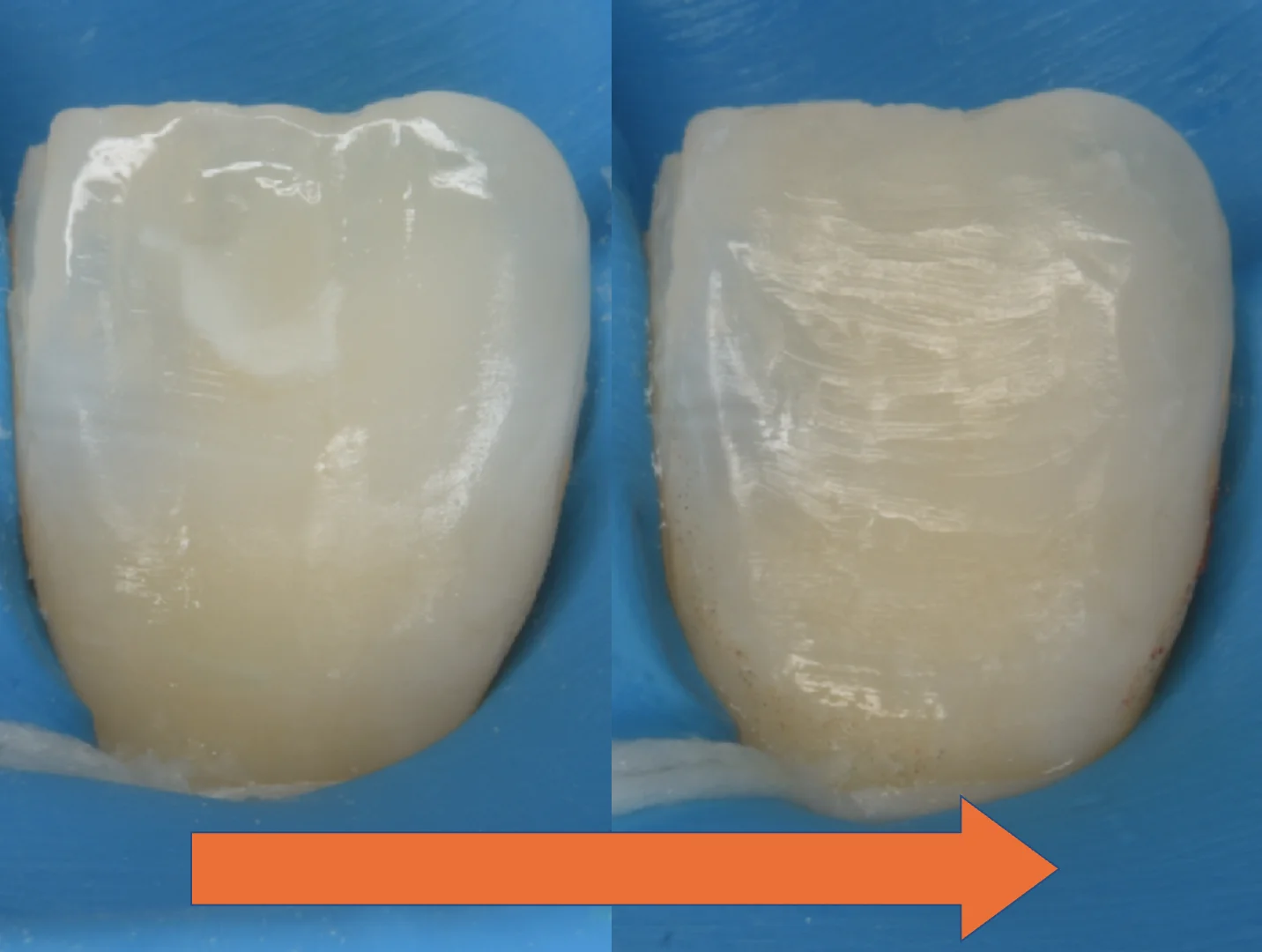 ICON治療にて改善しきらなかったケース。|坂寄歯科医院(取手市藤代) - 画像3