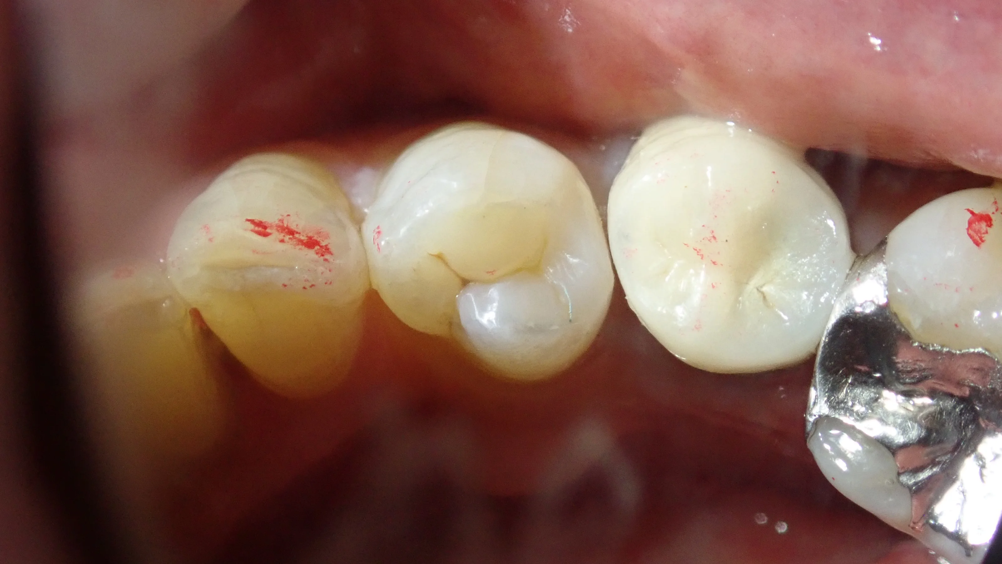 ダイレクトボンディング|坂寄歯科医院(取手市藤代) - 画像4