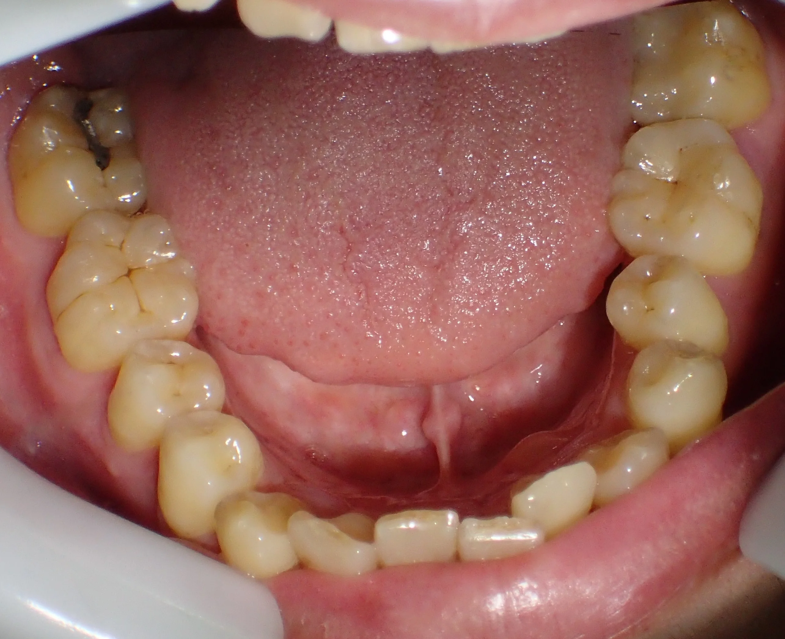 ダイレクトボンディングによる治療|坂寄歯科医院(取手市藤代) - 画像2