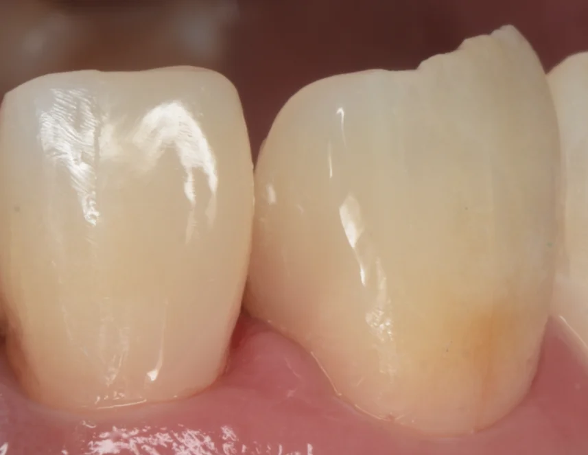 不適合なレジンを再治療。｜坂寄歯科医院（取手市藤代） - 画像3