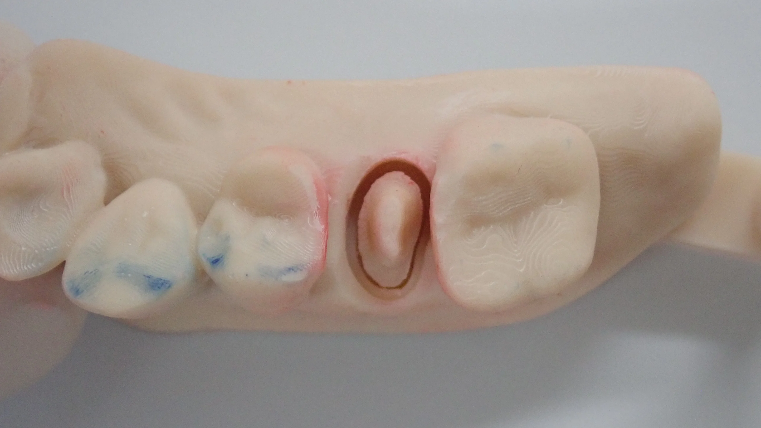 口腔内スキャナーでのセラミック｜坂寄歯科医院（取手市藤代） - 画像2