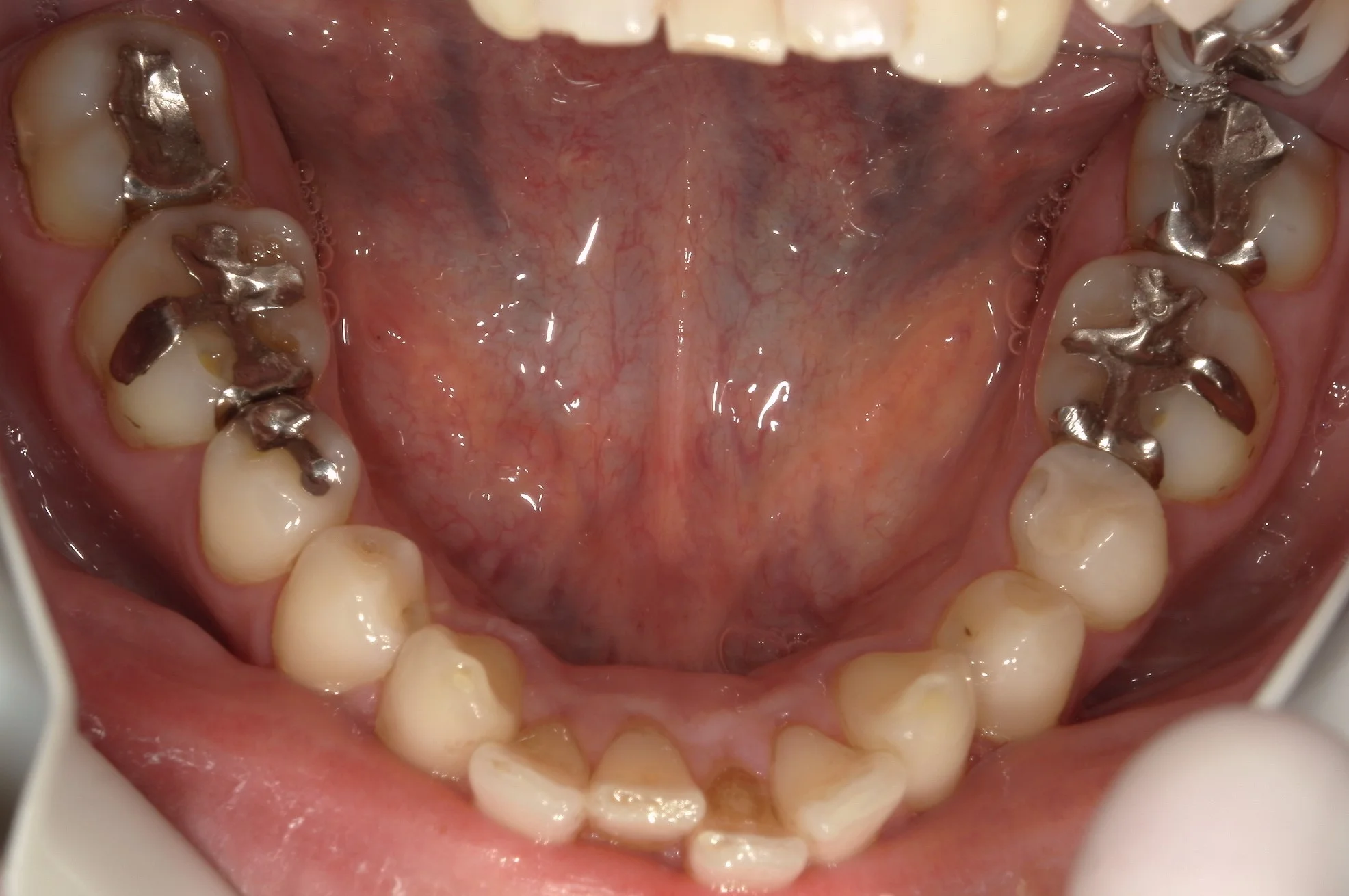 遠方から纏めて治療を希望の方。｜坂寄歯科医院（取手市藤代） - 画像6