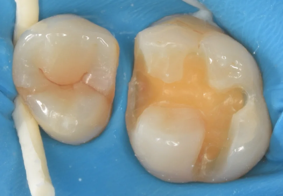 金属の詰め物を白い歯に。｜坂寄歯科医院（取手市藤代） - 画像2