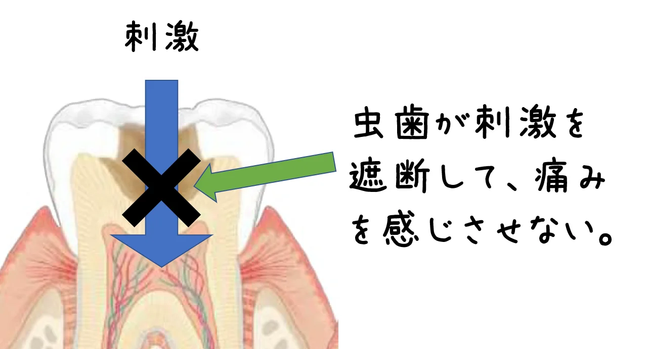 Q&A～今まで痛くなかった歯を治療したことで痛みが出てしまうのか～｜坂寄歯科医院（取手市藤代） - 画像3