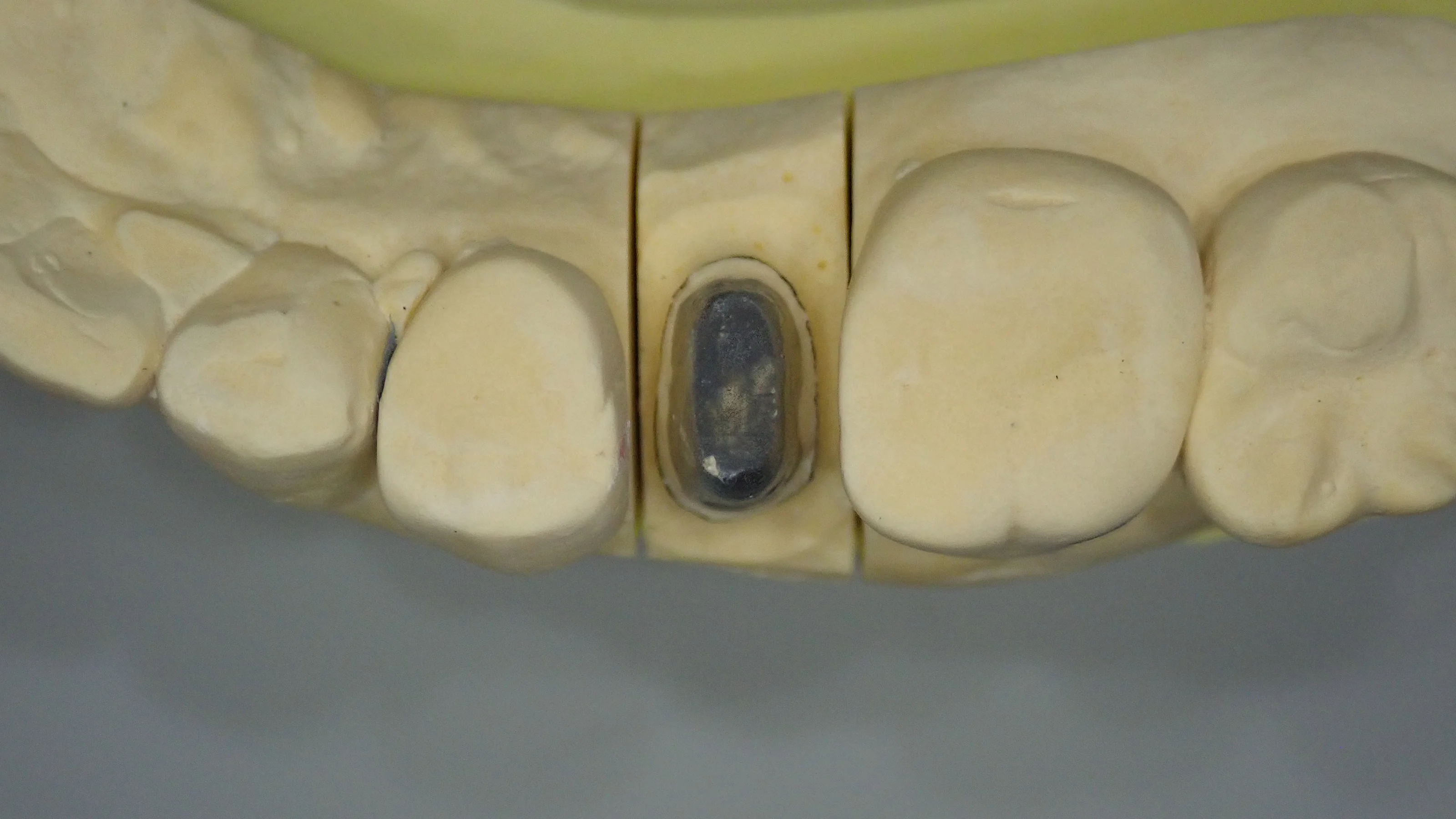メタルクラウン|坂寄歯科医院(取手市藤代) - 画像3