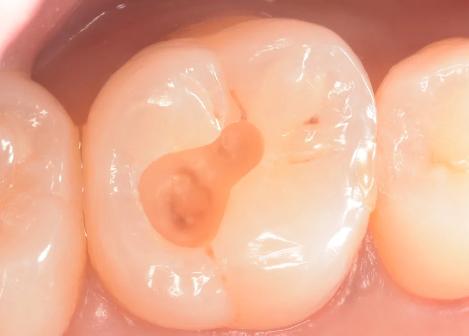 印西からお越しの方。｜坂寄歯科医院（取手市藤代） - 画像3