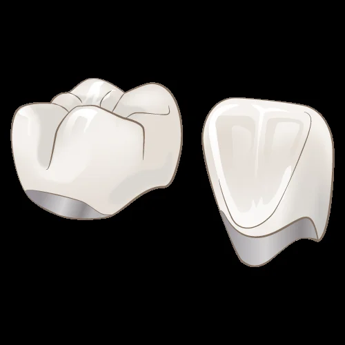 メタルボンドブリッジ｜坂寄歯科医院（取手市藤代） - 画像2