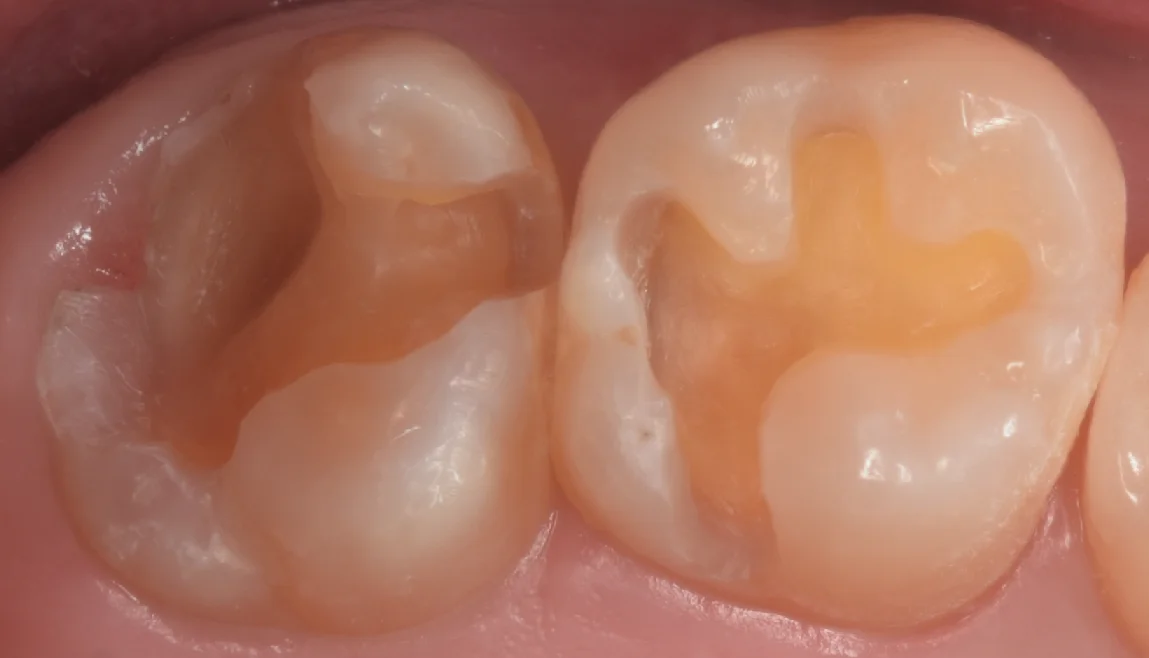 他院で入れたセラミックをダイレクトボンディングに。｜坂寄歯科医院（取手市藤代） - 画像3