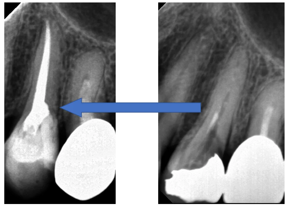 神経の治療⑤｜坂寄歯科医院（取手市藤代） - 画像5