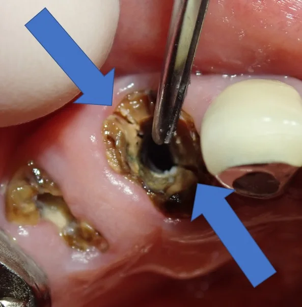 メタルコアによる歯根破折|坂寄歯科医院(取手市藤代) - 画像3