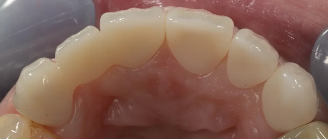 審美治療:セラミック|坂寄歯科医院(取手市藤代) - 画像5