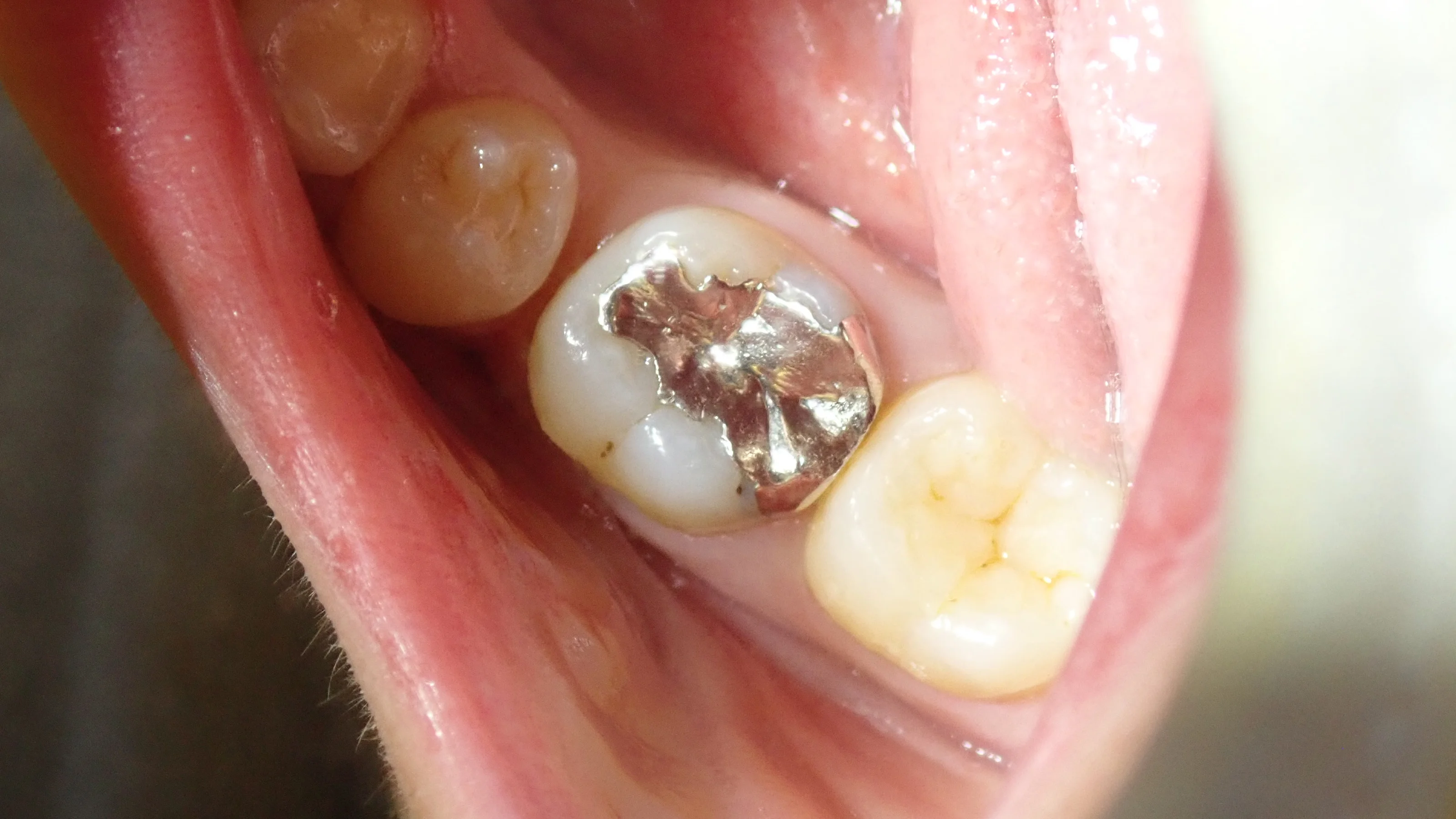 奥２本のダイレクトボンディング｜坂寄歯科医院（取手市藤代） - 画像4