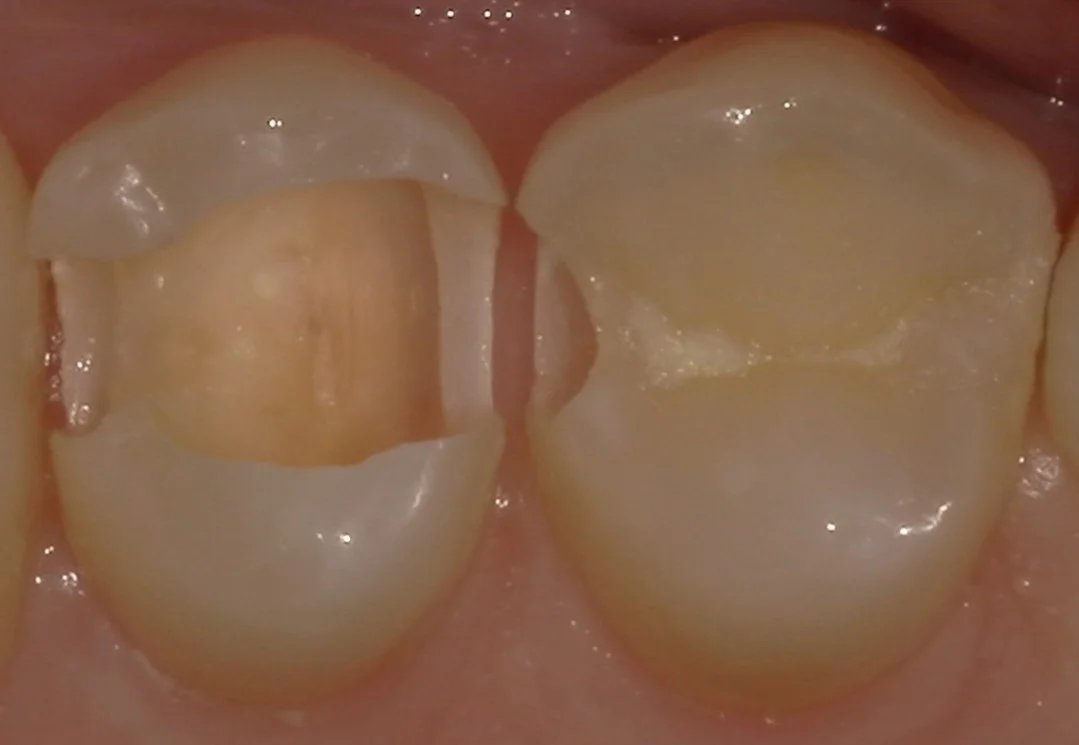 歯科医師の方の虫歯治療。｜坂寄歯科医院（取手市藤代） - 画像3