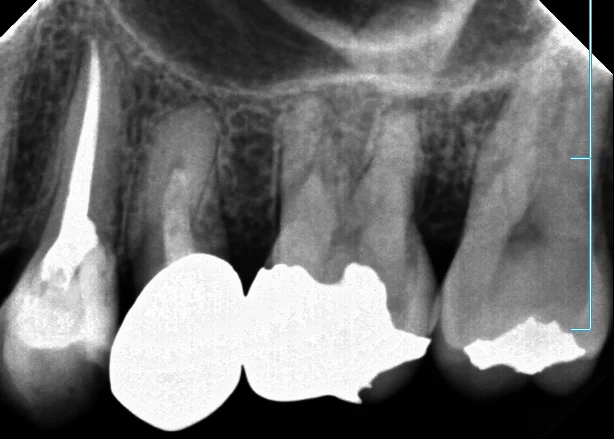 神経の治療⑤｜坂寄歯科医院（取手市藤代） - 画像4