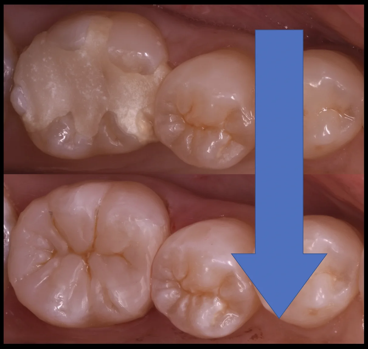 詰め物が脱離した所を即日で白い詰め物に。|坂寄歯科医院(取手市藤代) - 画像5
