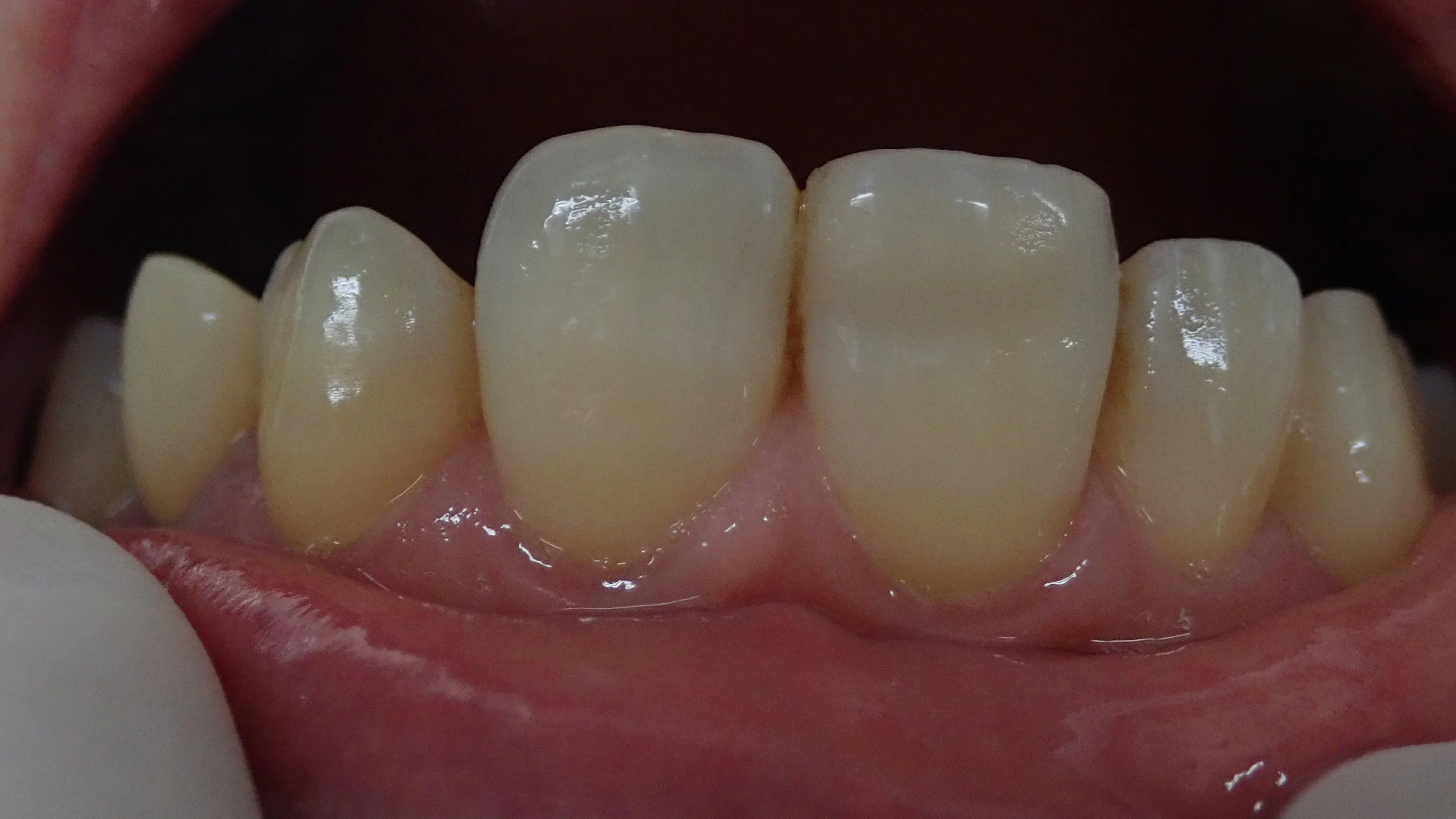 前歯ダイレクトボンディング②｜坂寄歯科医院（取手市藤代） - 画像3